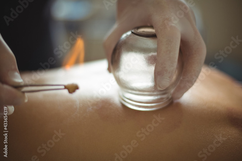Hands of therapist performing cupping therapy, heating jar held on the back of patient