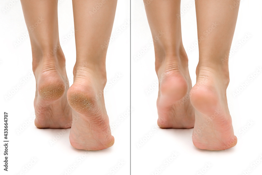 Feet with dry skin before and after treatment. comparison of a dry heel and a healthy foot. keratinized skin on the foot. treatment of corns - obrazy, fototapety, plakaty 