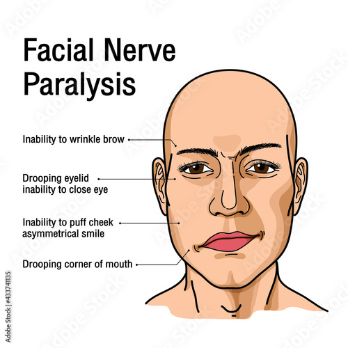 Paralysis of the facial nerve. Bell's palsy. Vector