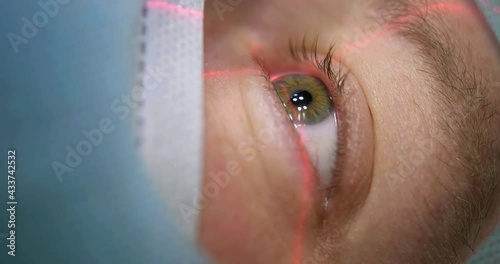 Laser vision correction. Close-up view of the patient's eye lying on the operating table before ophthalmic operation in the operating room.