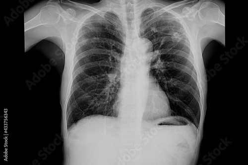Chest xray of a patient with old TB