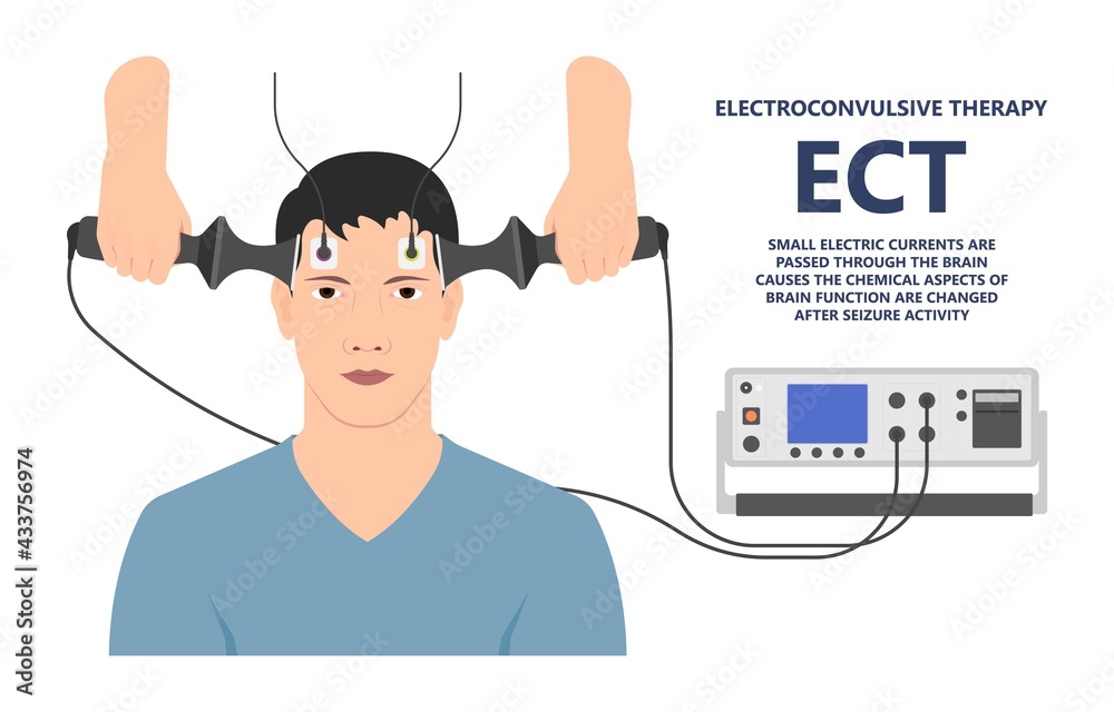 ECT treat MDD Major TMS electric current brain mental health mania