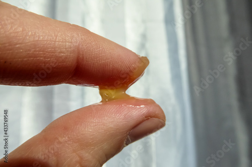 Gelbe Creme. Konsistenzprüfung zwischen Daumen und Zeigefinger. Disgusting yellow ointment between fingers viscosity.