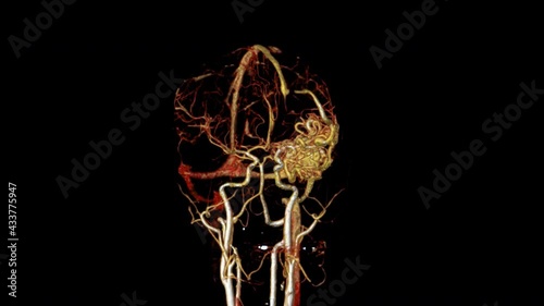CTA Brain or computed tomography angiography of the brain 3D rendering image showing Brain AVM or arteriovenous malformation turn around on the screen.