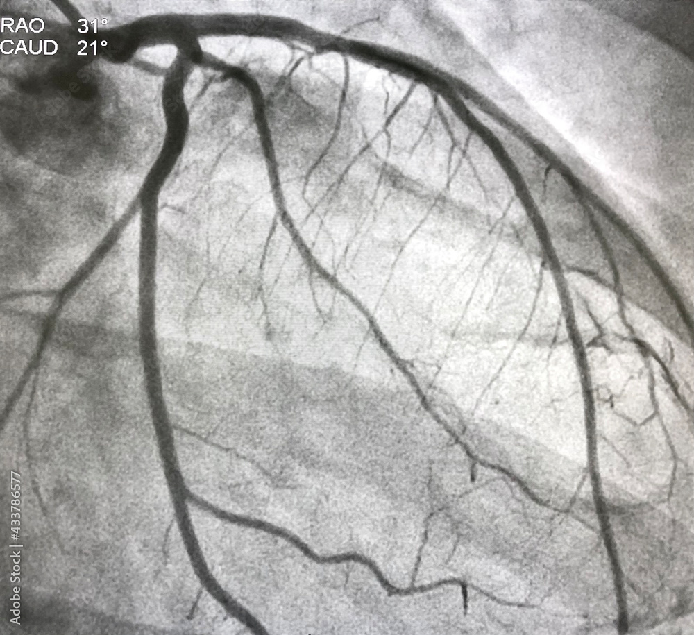 Normal Coronary Angiogram Of Left Coronary Artery During Cardiac