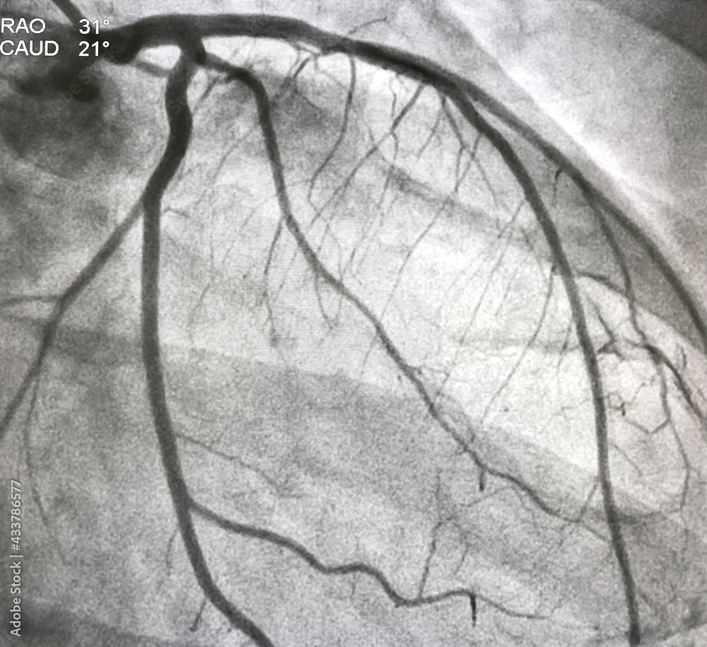 Normal Coronary Angiogram Of Left Coronary Artery During Cardiac 