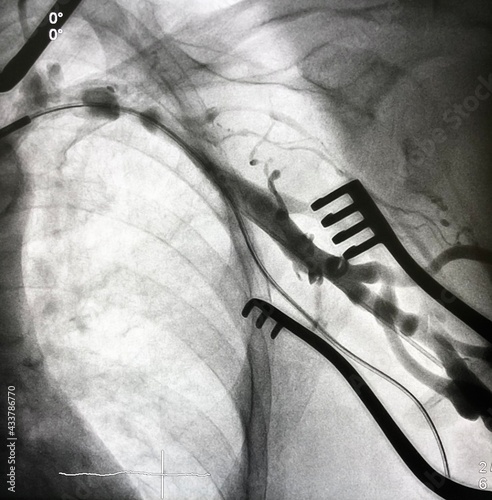 X ray image during permanent pacemaker implantation procedure. photo