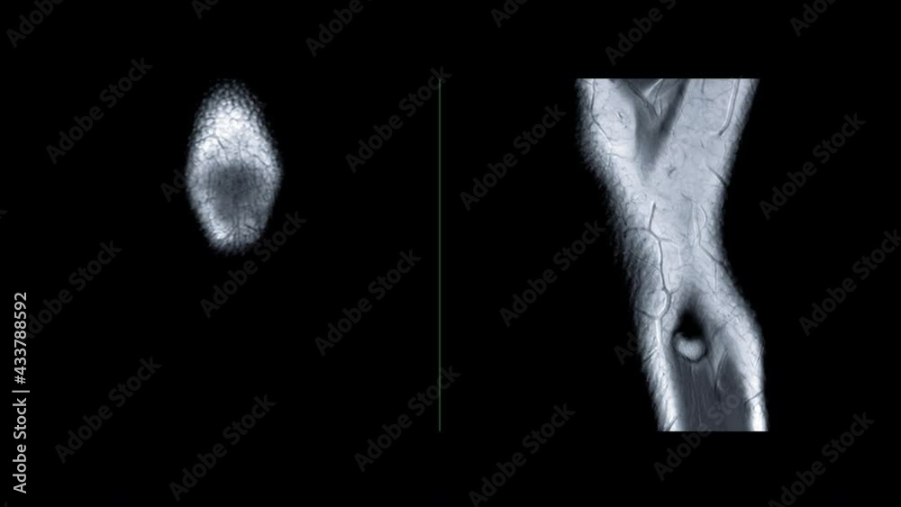 MRI Knee joint or magnetic resonance imaging of the knee compare PDW ...