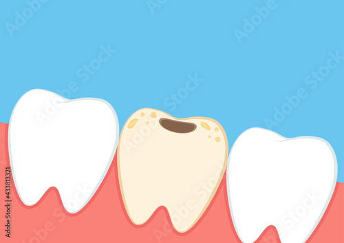 Teeth cartoon vector. dental equipment vector. Tartar buildup are common dental. Tooth cavity.