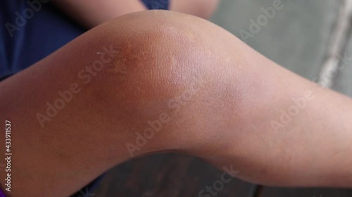 Close Up of terrible skin scars. Marks from a bad accident, surgery,