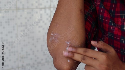Close Up of terrible skin scars. Marks from a bad accident, surgery,