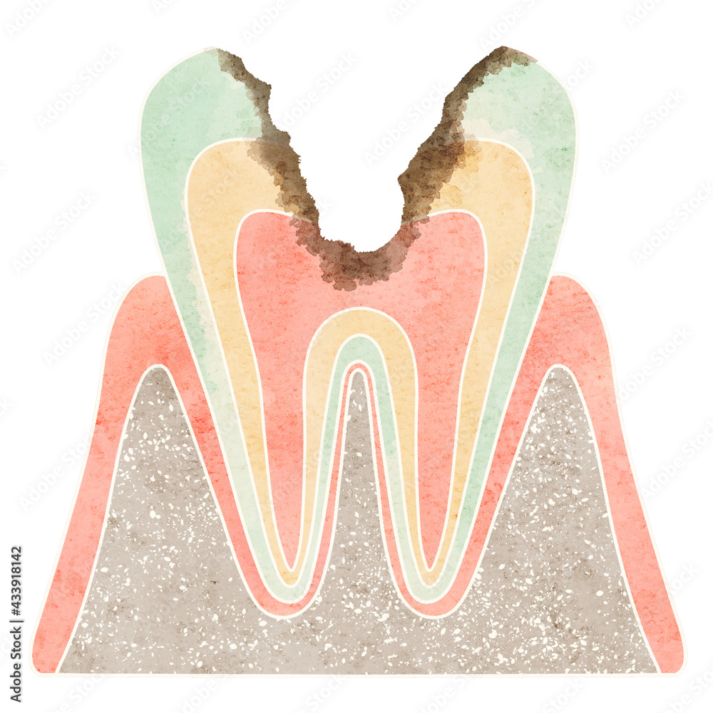虫歯になった歯の断面（C3） - obrazy, fototapety, plakaty 