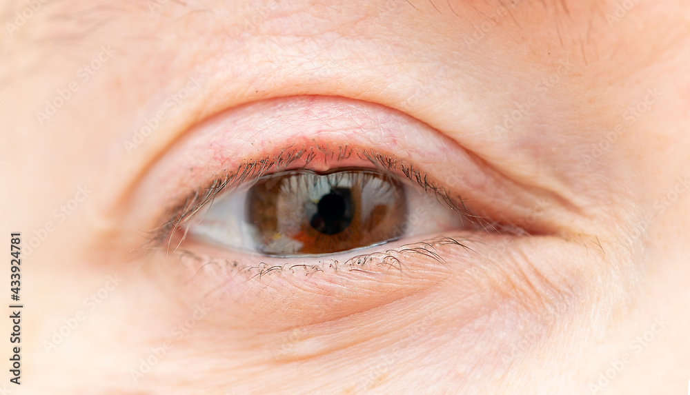 Obraz premium Close up of a woman's eye with a bacterial infection of an oil gland in the lower eyelid.