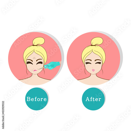 Before and after collagen injection skin solution cartoon, illustration vector.