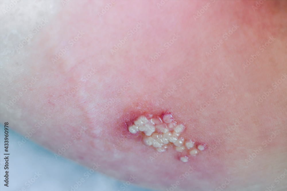 Shingles. Close-up of blisters around the groin of a 76-year-old female  patient with shingles. Shingles is a disease caused by the Herpes zoster  virus Stock Photo - Alamy