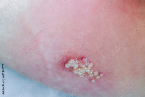 Woman with Shingles or Herpes Zoster on skin, it is raised red bumps and blisters caused on body. Medicine treatment for varicella-zoster virus infection concept. photo