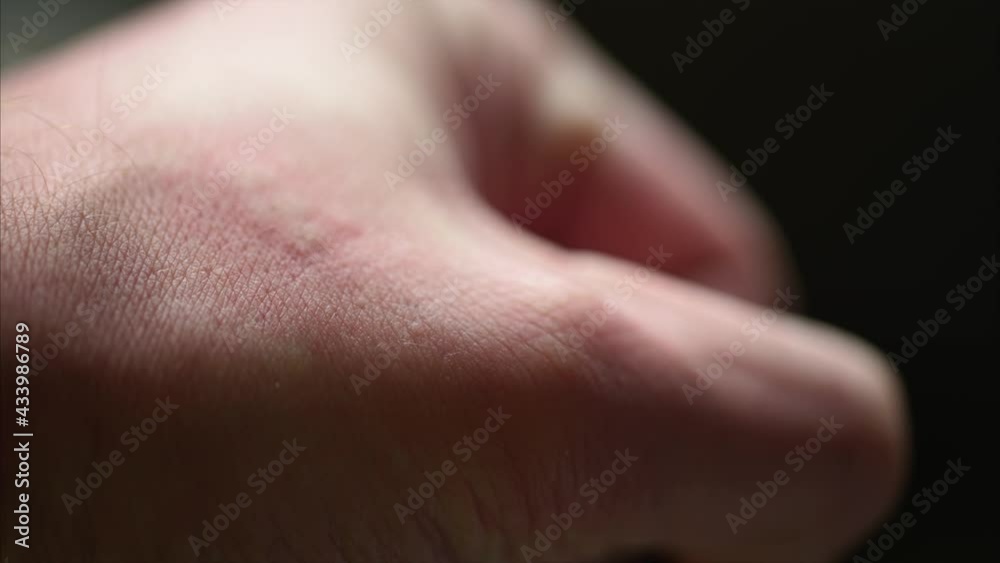 Allergic rash after contact allergy: pustules, spots, blisters and wheals on the skin as allergic reaction