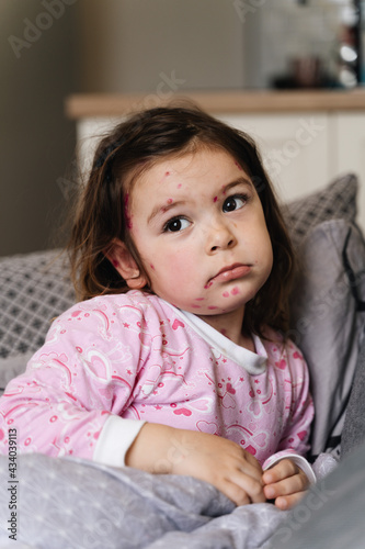 Obraz na plátně Toddler girl with chickenpox measles on the body