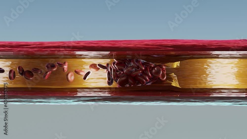 Vascular occlusion is a blockage of a blood vessel, usually with a clot. 3d render. cross section. heart attack