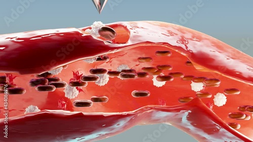 Hemostasis. Red blood cells and platelets in the blood vessel. Basic steps of wound healing process. animation. 3d render. cross section photo
