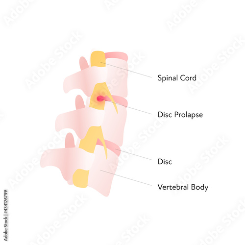 Spine cord vector flat anatomical illustration with text and disc prolapse. Design for science, biology, health care.