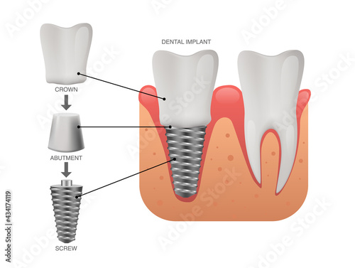 Dental implant structure, human teeth and dental implant, vector illustration