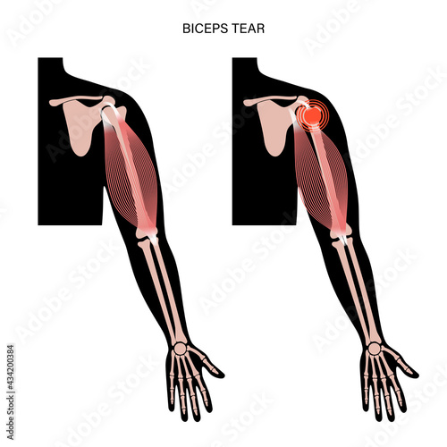 Biceps tear trauma
