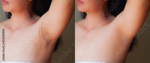Photos Image before and after skincare cosmetology armpits epilation treatment concept