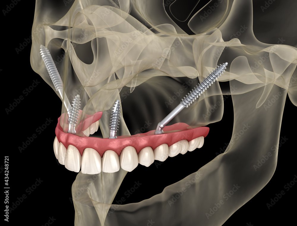 Maxillary Prosthesis Maxillary prosthesis supported by zygomatic implants. Medically ...