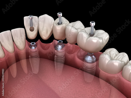 Dental bridge based on 3 implants. Medically accurate 3D illustration of human teeth and dentures concept photo