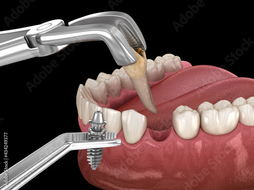 Photography Extraction and Implantation, complex immediate surgery