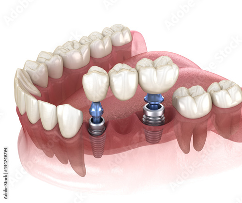 Fototapeta Naklejka Na Ścianę i Meble -  Dental bridge supported by implants. Medically accurate 3D illustration of human teeth and dentures concept