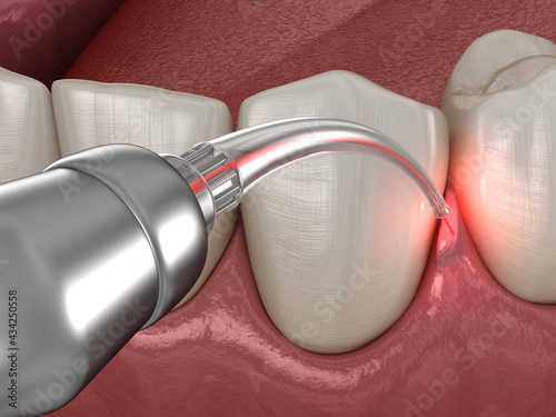 Gum correction surgery with laser.  Medically accurate tooth 3D illustration photo