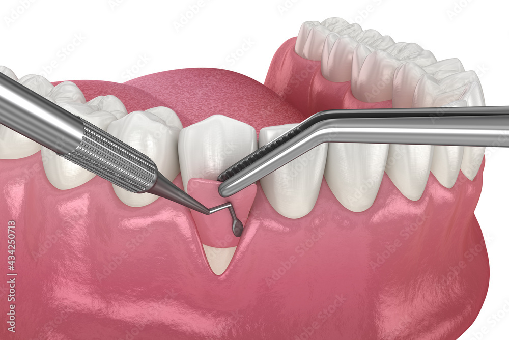 Gum Recession: Soft tissue graft surgery. 3D illustration of Dental  treatment - obrazy, fototapety, plakaty 