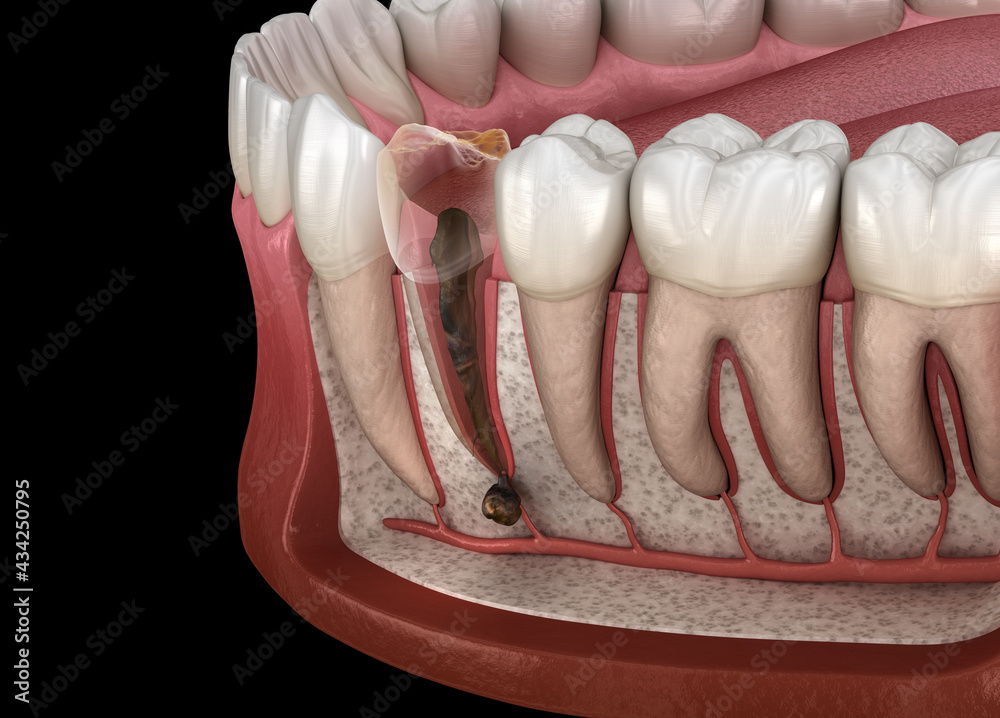 Periostitis tooth Lump on Gum Above Tooth. Medically accurate dental