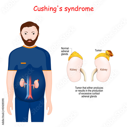 Cushing's syndrome. Close-up of adrenal gland with tumor.