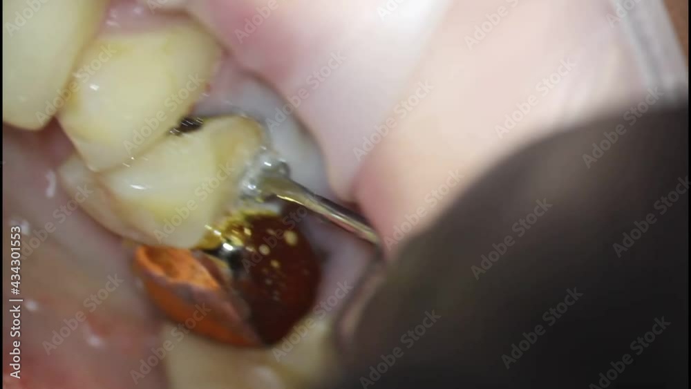 dentistry. shooting with a microscope. dental treatment. placement of a