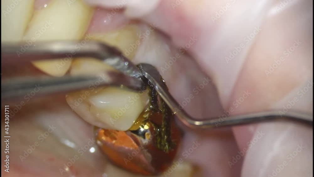 dentistry. shooting with a microscope. dental treatment. placement of a retraction cord or