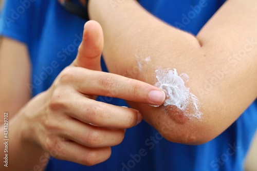 Close up at Asian woman's hand is applying medical cream at keloid scar (Hypertrophic Scar) at her elbow cause by bicycle accidental.Concepts of health care and beauty.