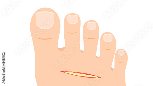 Lesion on foot vector. free space for text. copy space. pus on lesion.