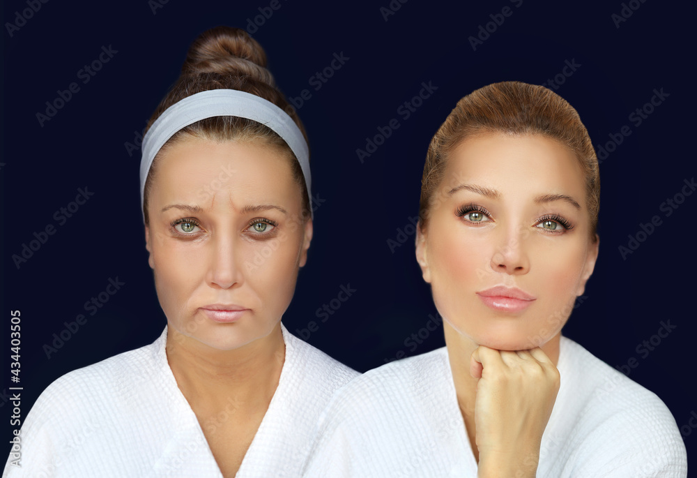 Plastic Surgery Results.Frown/scowl lines ,Nasolabial folds,Neck ,Under eye circles,neck lines