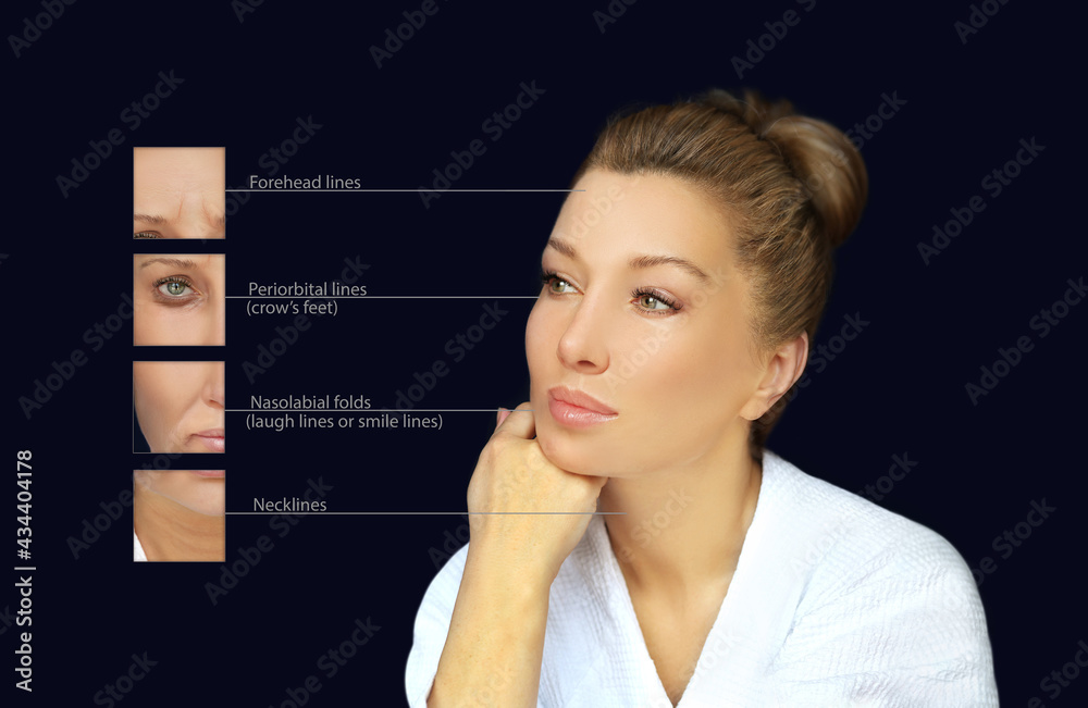 Plastic Surgery Results.Frown/scowl lines ,Nasolabial folds,Neck ,Under eye circles,neck lines