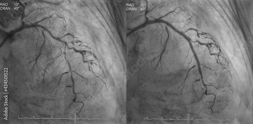 Comparison of pre-post percutaneous coronary intervention (PCI) at proximal to mid left anterior descending artery (LAD) with drug eluting stent (DES). photo
