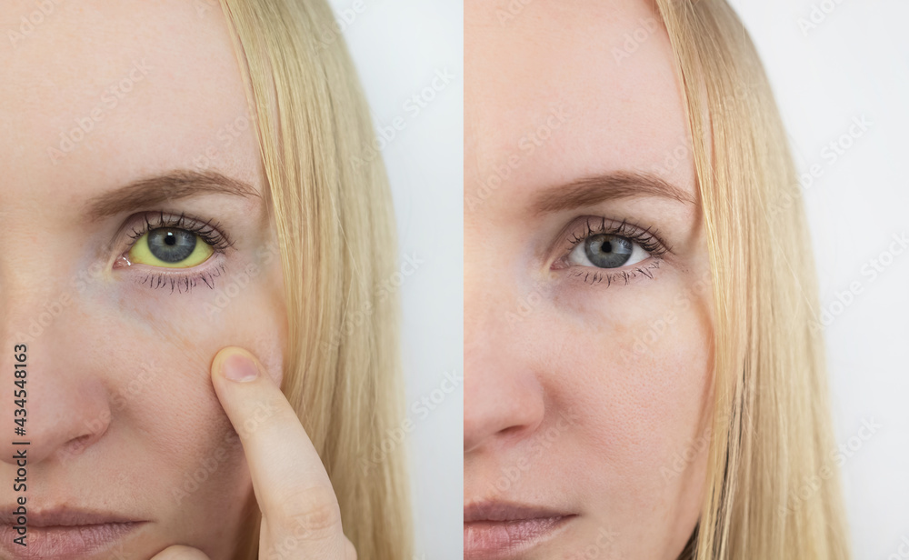 Foto de Before and after. Left yellow eye, right normal. Symptom of
