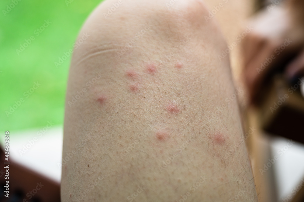 Naklejka premium Swollen blisters on the skin caused by mosquito bites at thigh