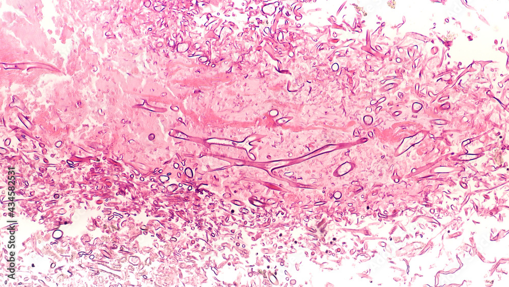 Fungal Infection Mucormycosis Broad, wideangle nonseptate hyphae