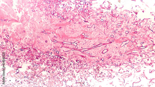 Fungal Infection - Mucormycosis: Broad, wide-angle non-septate hyphae of the fungus Mucor, from the paranasal sinus of a patient with uncontrolled diabetes mellitus.  Hematoxylin and Eosin (HE) stain photo
