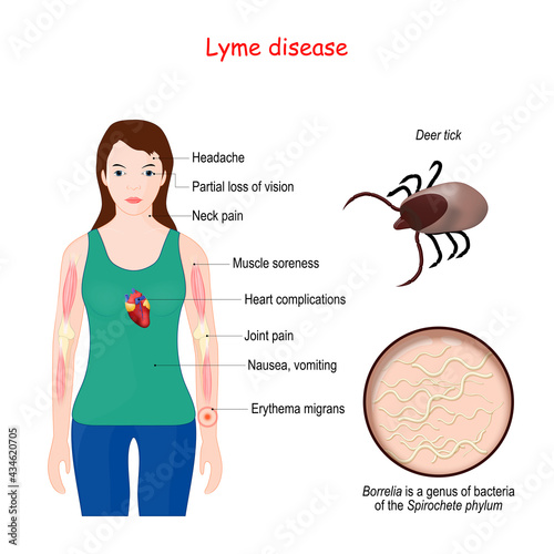 Lyme disease