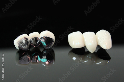 Porcelain fused to metal. PFM bridge