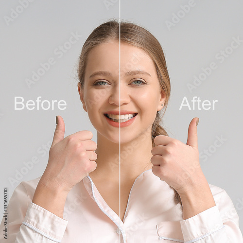 Slika na platnu Beautiful young woman before and after smile makeover procedure on grey backgrou